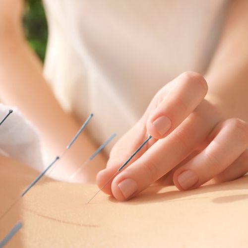 Acupuncture treatment